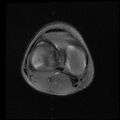 Bucket handle tear - lateral meniscus (Radiopaedia 72124-82634 Axial PD fat sat 10).jpg