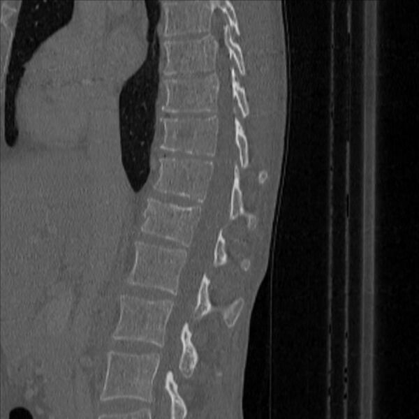File:Bulging of paraspinal line in traumatic thoracal spinal compression fracture (Radiopaedia 29221-35872 Sagittal bone window 20).jpg