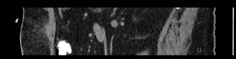 File:Buried bumper syndrome - gastrostomy tube (Radiopaedia 63843-72575 Sagittal Inject 46).jpg