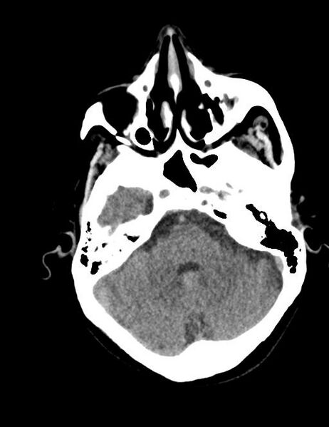 File:Burnt-out meningioma (Radiopaedia 51557-57337 Axial non-contrast 9).jpg