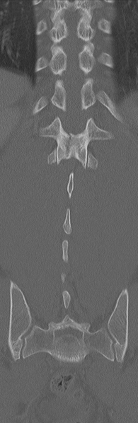File:Burst fracture - T12 with conus compression (Radiopaedia 56825-63647 Coronal bone window 31).png