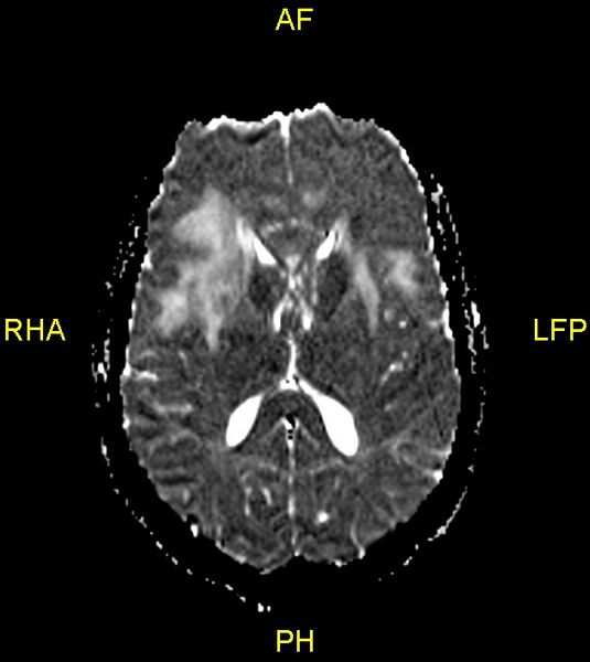 File:Butterfly glioma (Radiopaedia 76707-88526 Axial ADC 15).jpg