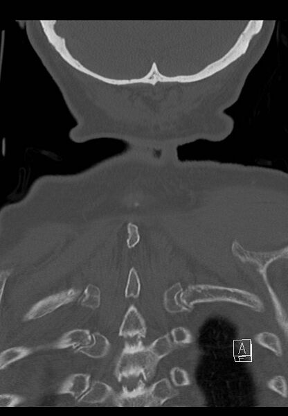 File:C1 and C2 (peg) fractures (Radiopaedia 36618-38184 Coronal bone window 51).jpg