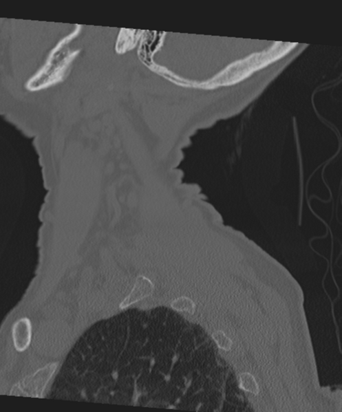 File:C2 fracture with vertebral artery dissection (Radiopaedia 37378-39199 Sagittal bone window 12).png