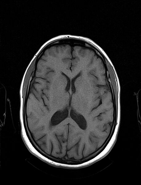 File:Calcified cerebral hydatid cyst (Radiopaedia 65603-74699 Axial T1 13).jpg
