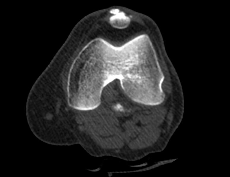 File:Calcified hematoma - popliteal fossa (Radiopaedia 63938-72763 Axial bone window 5).jpg