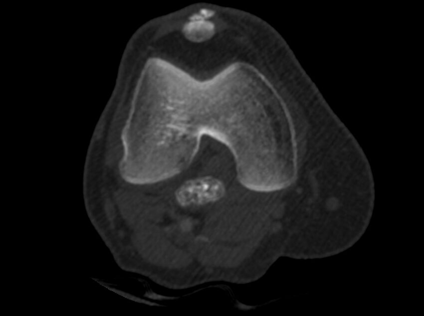 Calcified hematoma - popliteal fossa (Radiopaedia 63938-72763 C 7).jpg