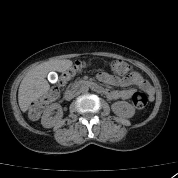 File:Calcified hepatic hydatid cyst (Radiopaedia 26872-27046 Axial non-contrast 41).jpg