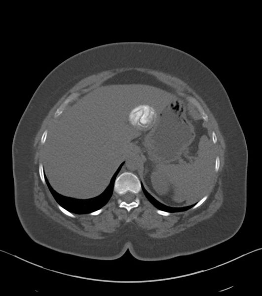 File:Calcified hepatic hydatid cyst (Radiopaedia 81127-94738 Axial non-contrast 21).jpg