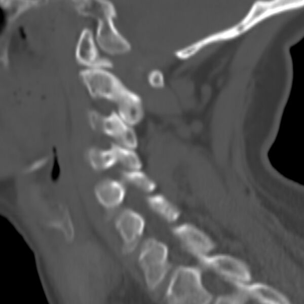 File:Calcified meningioma - cervical canal (Radiopaedia 70136-80171 Sagittal bone window 7).jpg