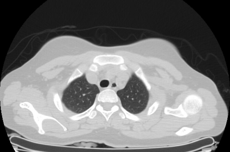File:Cannonball metastases - uterine choriocarcinoma (Radiopaedia 70137-80173 Axial lung window 1).jpg