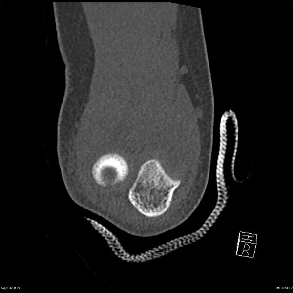 File:Capitellum fracture (Radiopaedia 23352-23426 Coronal bone window 37).jpg