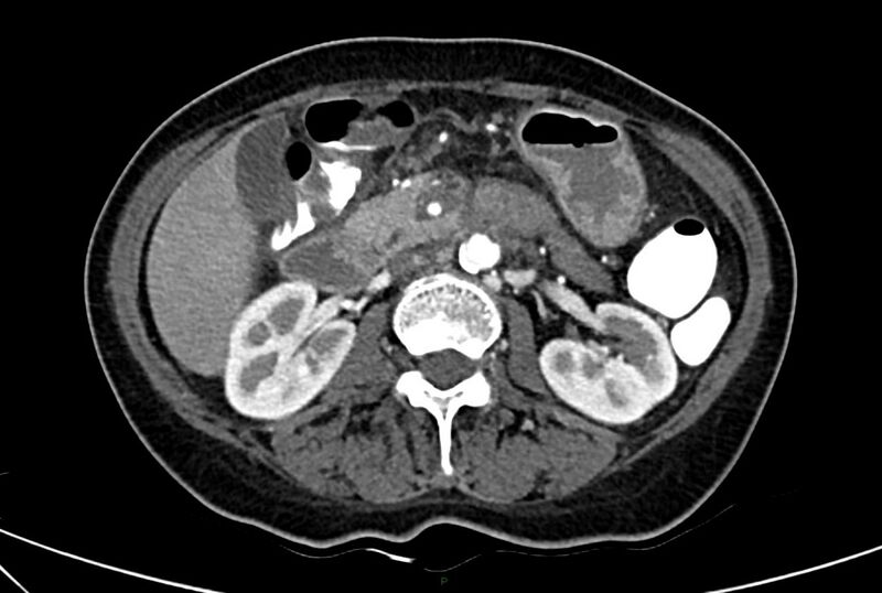 File:Carcinoid mesenteric tumor complicated by chylous ascites (Radiopaedia 76312-88926 A 29).jpg
