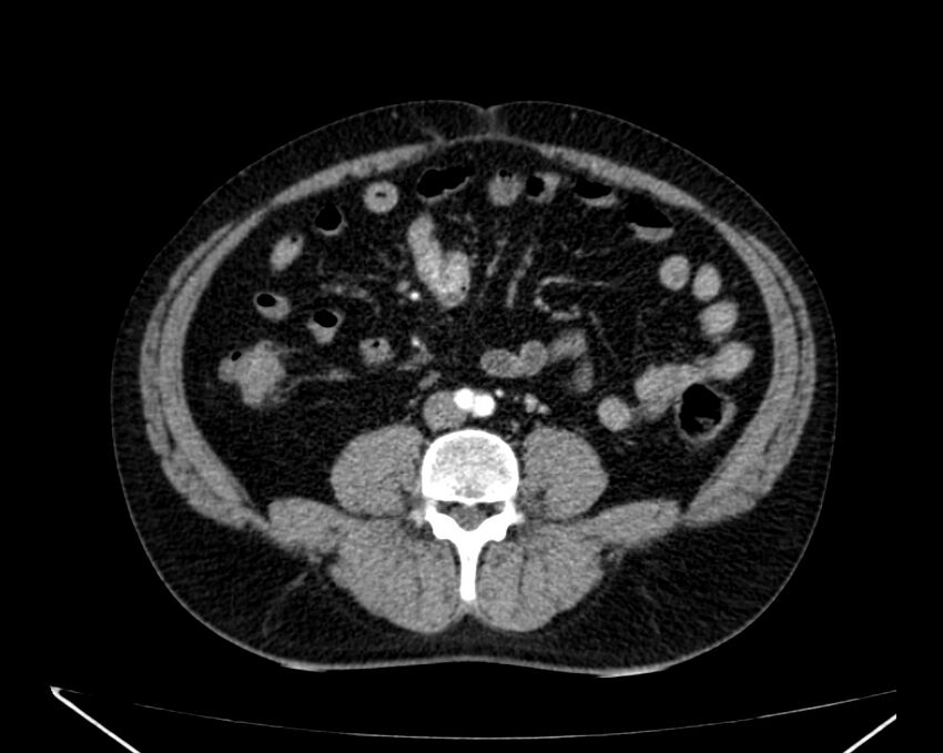 Carcinoid tumor with hepatic metastases (Radiopaedia 22651-22670 B 53).jpg