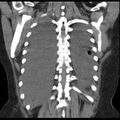 Cardiogenic pulmonary edema (Radiopaedia 29213-29609 Coronal non-contrast 35).jpg