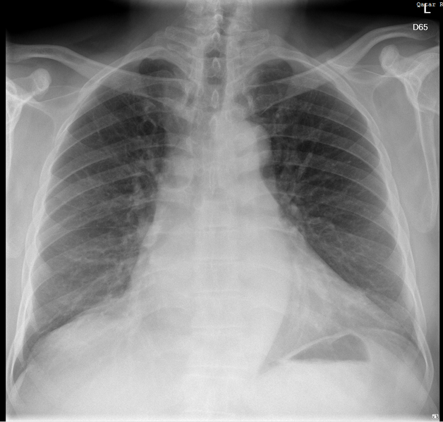 File:Cardiomegaly with left atrium enlargement (Radiopaedia 84873-100367 Frontal 1).PNG
