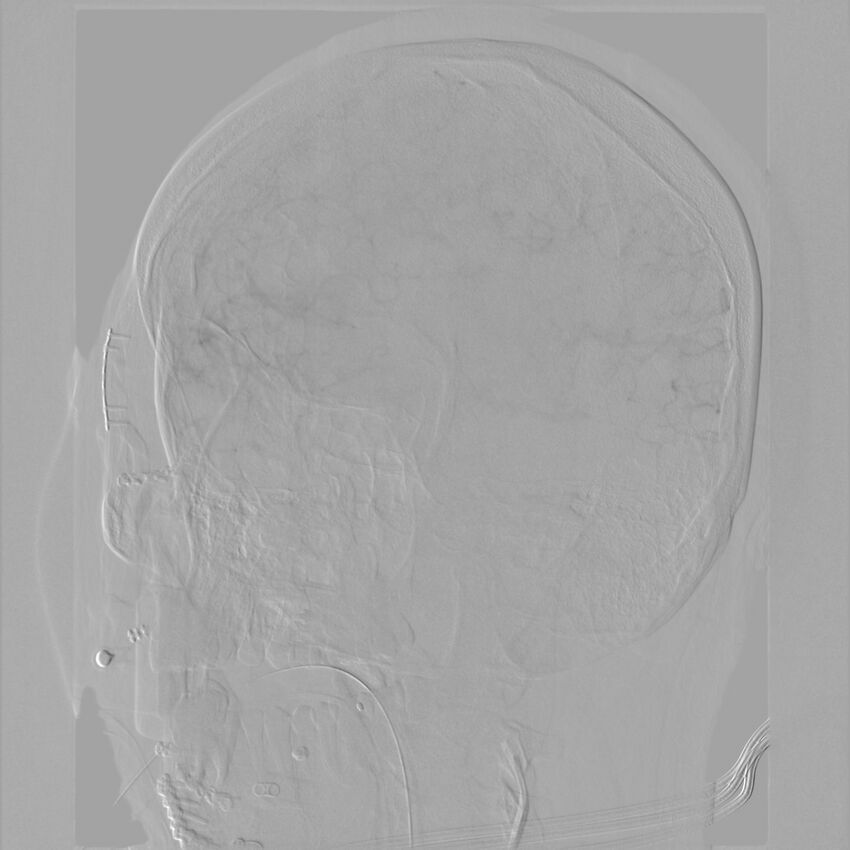 Caroticocavernous fistula - direct (Radiopaedia 61660-69666 Oblique Left ICA 34).jpg
