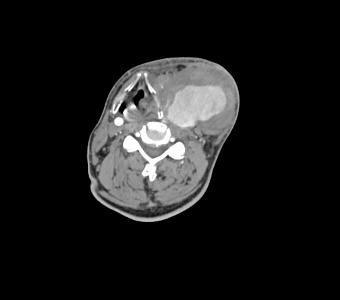 File:Carotid artery pseudoaneurysm (Radiopaedia 84030-99259 C 47).jpg