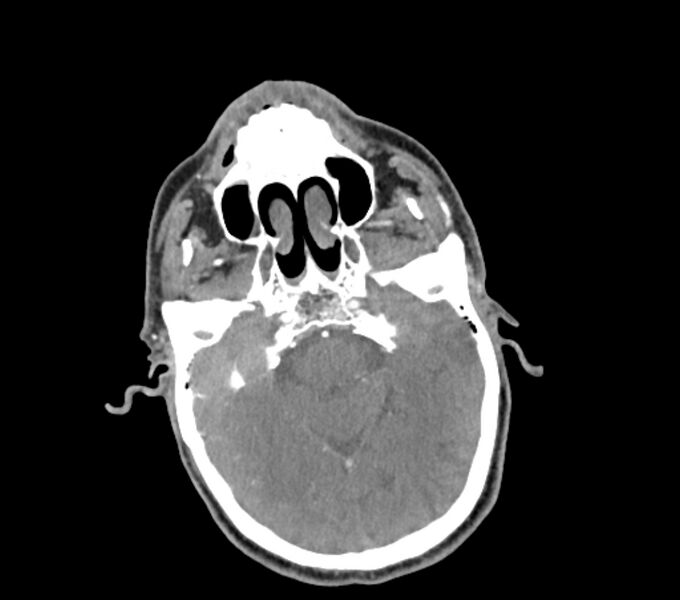 File:Carotid artery pseudoaneurysm (Radiopaedia 84030-99259 C 6).jpg