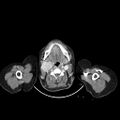 Carotid body tumor (Radiopaedia 21021-20948 A 17).jpg