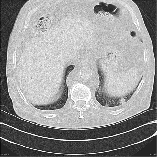 File:Cavitating left lower lobe lesion - squamous cell lung cancer (Radiopaedia 27749-28176 Axial lung window 43).jpg
