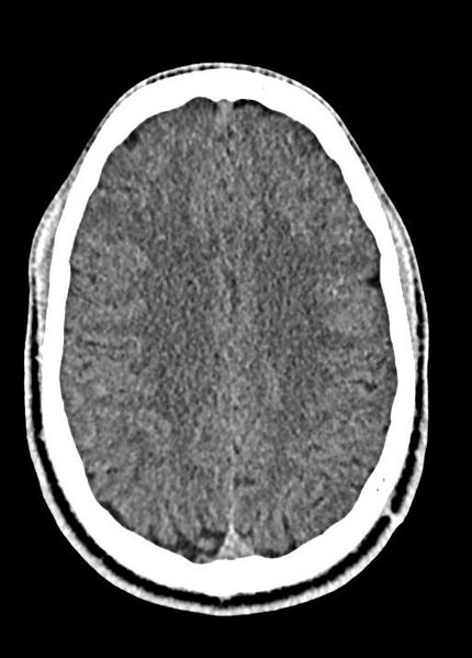 File:Cavum septum pellucidum and cavum vergae (Radiopaedia 77797-90060 Axial Brain Window 72).jpg