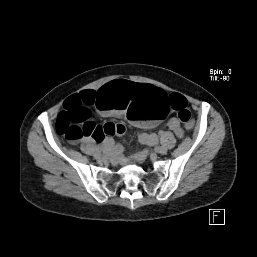 Cecal volvulus (Radiopaedia 90897-108397 Axial non-contrast 49).jpg