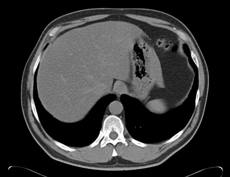 File:Centrilobular pulmonary emphysema (Radiopaedia 26808-26971 Axial non-contrast 39).jpg