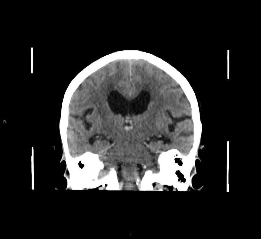Cerebellar hemorrhage (Radiopaedia 58793-66027 Coronal non-contrast 34).jpg