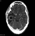 Cerebral abscess (Radiopaedia 6022-7523 Axial C+ delayed 1).jpg