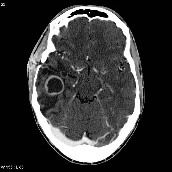 File:Cerebral abscess (Radiopaedia 6022-7523 Axial C+ delayed 1).jpg