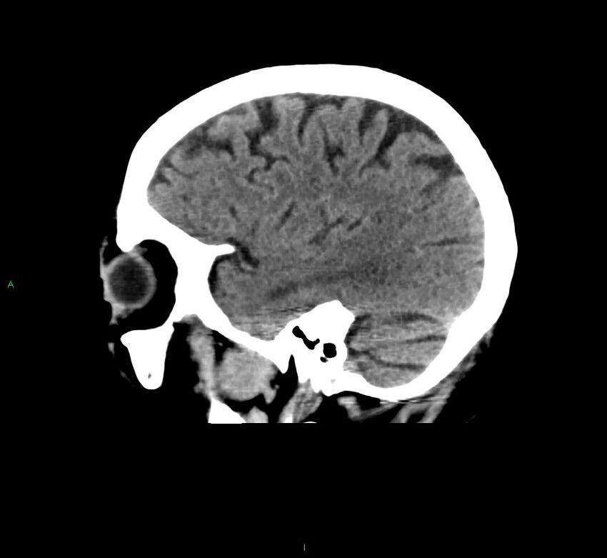 Cerebral amyloid angiopathy-associated lobar intracerebral hemorrhage (Radiopaedia 58376-65511 C 14).jpg