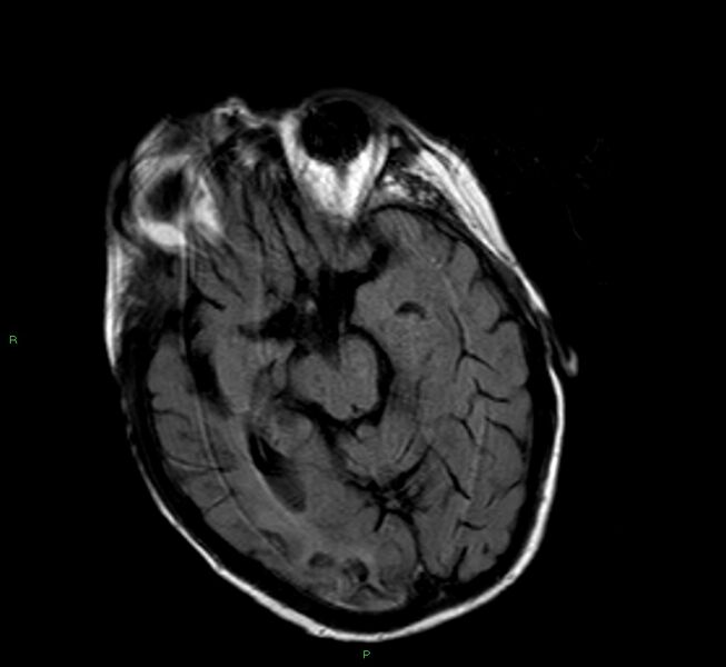 File:Cerebral amyloid angiopathy-associated lobar intracerebral hemorrhage (Radiopaedia 58377-65515 Axial FLAIR 17).jpg
