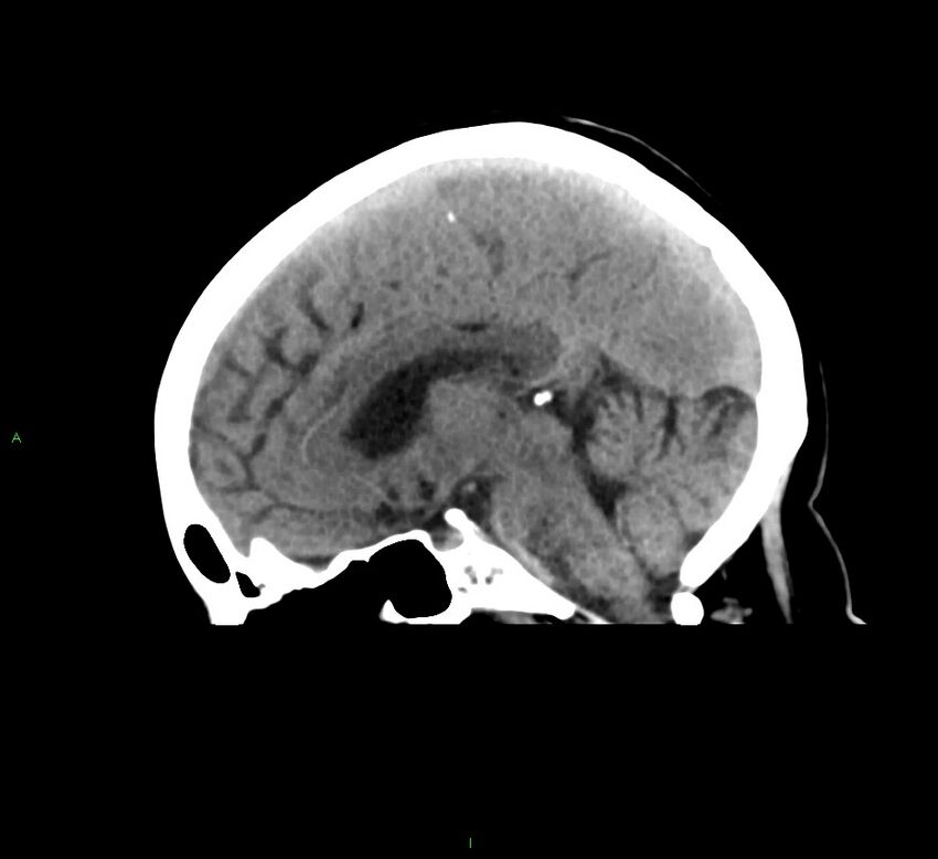 Cerebral amyloid angiopathy-associated lobar intracerebral hemorrhage (Radiopaedia 58378-65516 C 25).jpg