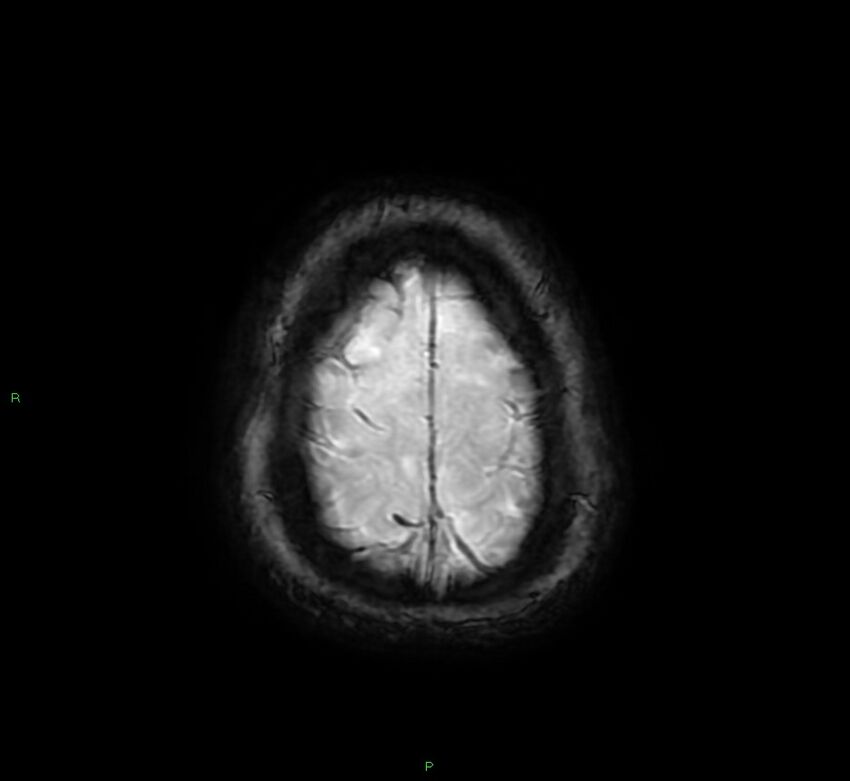 Cerebral amyloid angiopathy-associated lobar intracerebral hemorrhage (Radiopaedia 58378-65517 Axial SWI 66).jpg