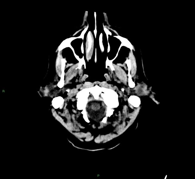 File:Cerebral amyloid angiopathy-associated lobar intracerebral hemorrhage (Radiopaedia 58529-65681 Axial non-contrast 50).jpg