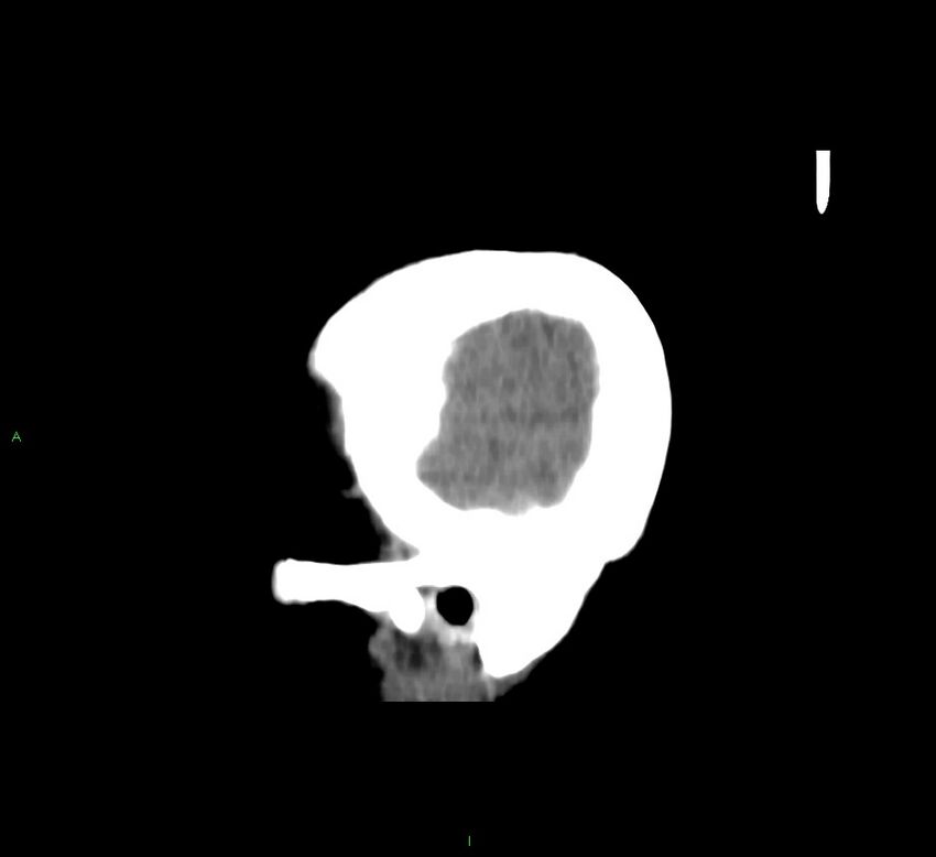 Cerebral amyloid angiopathy-associated lobar intracerebral hemorrhage (Radiopaedia 58751-65972 C 48).jpg