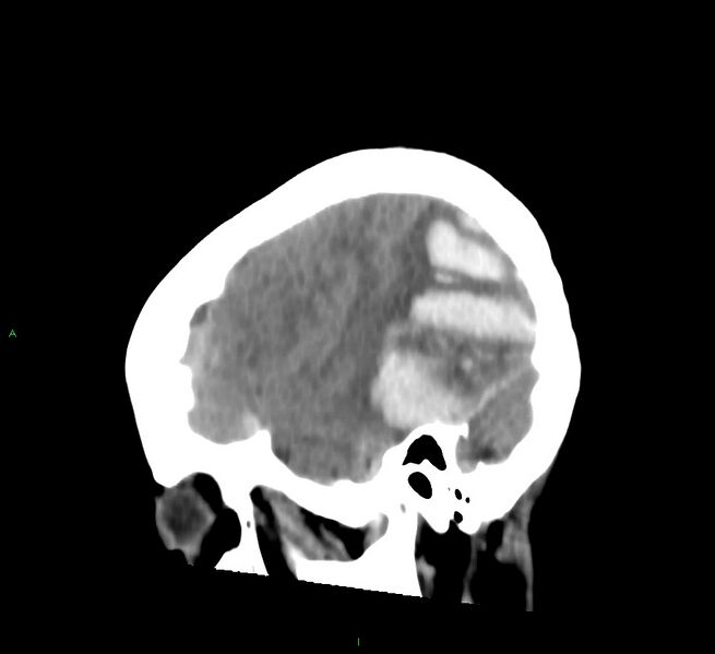 File:Cerebral amyloid angiopathy-associated lobar intracerebral hemorrhage (Radiopaedia 58754-65975 C 39).jpg