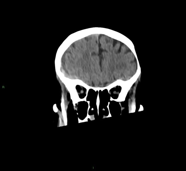File:Cerebral amyloid angiopathy-associated lobar intracerebral hemorrhage (Radiopaedia 58758-65980 Coronal non-contrast 48).jpg