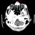 Cerebral and orbital tuberculomas (Radiopaedia 13308-13310 B 6).jpg