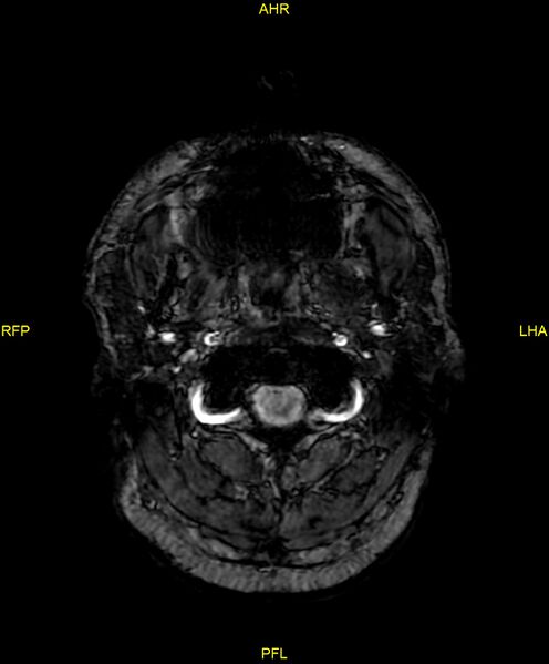 File:Cerebral autosomal dominant arteriopathy with subcortical infarcts and leukoencephalopathy (CADASIL) (Radiopaedia 86108-102054 Axial SWI 2).jpg