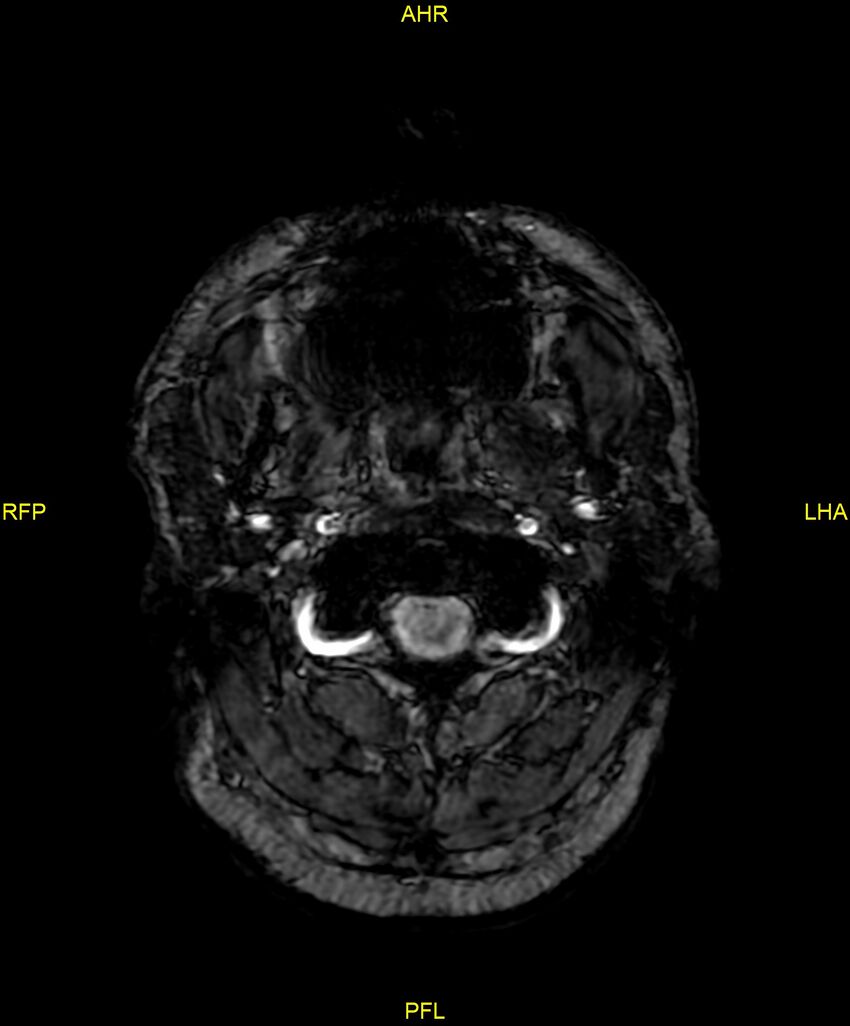 Cerebral autosomal dominant arteriopathy with subcortical infarcts and leukoencephalopathy (CADASIL) (Radiopaedia 86108-102054 Axial SWI 2).jpg