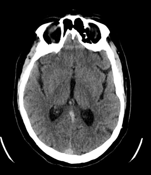 File:Cerebral dural venous sinus thrombosis (Radiopaedia 86514-102575 Axial non-contrast 22).jpg
