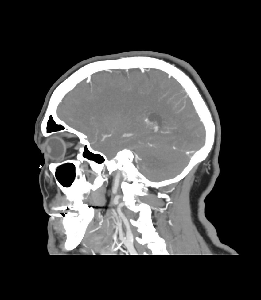 Cerebral dural venous sinus thrombosis (Radiopaedia 86514-102576 C 15).jpg