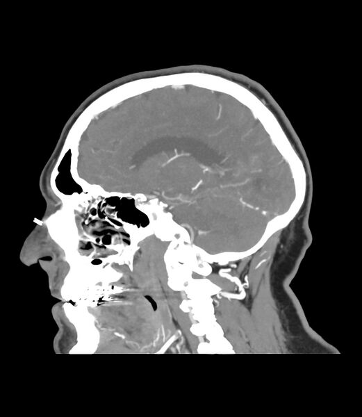 File:Cerebral dural venous sinus thrombosis (Radiopaedia 86514-102576 C 34).jpg