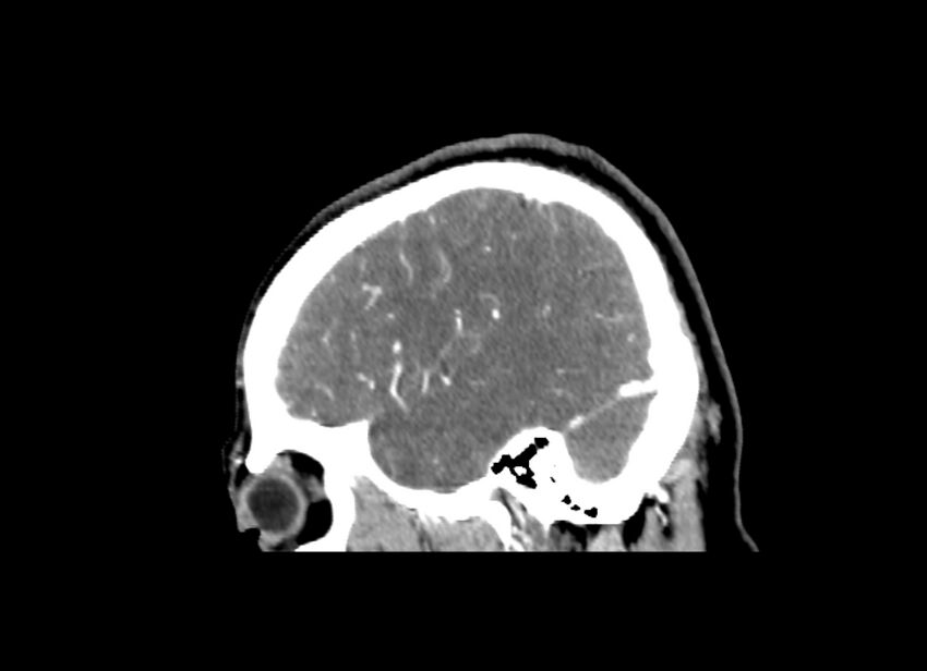 Cerebral edema (Radiopaedia 82519-96661 D 13).jpg