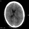Cerebral hemorrhagic contusion with subdural and subarachnoid hemorrhage (Radiopaedia 10680-11146 Axial non-contrast 15).jpg