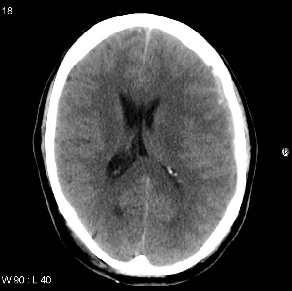 File:Cerebral hemorrhagic contusion with subdural and subarachnoid hemorrhage (Radiopaedia 10680-11146 Axial non-contrast 15).jpg