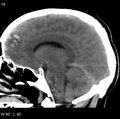 Cerebral hemorrhagic contusion with subdural and subarachnoid hemorrhage (Radiopaedia 10680-11146 C 11).jpg
