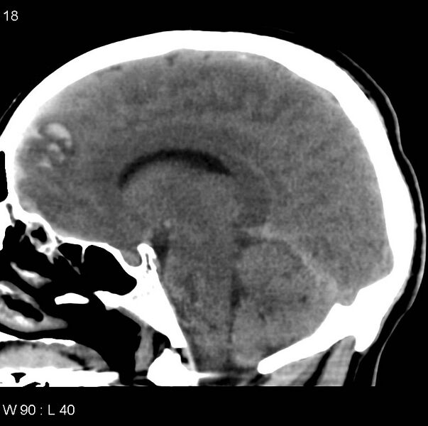 File:Cerebral hemorrhagic contusion with subdural and subarachnoid hemorrhage (Radiopaedia 10680-11146 C 11).jpg
